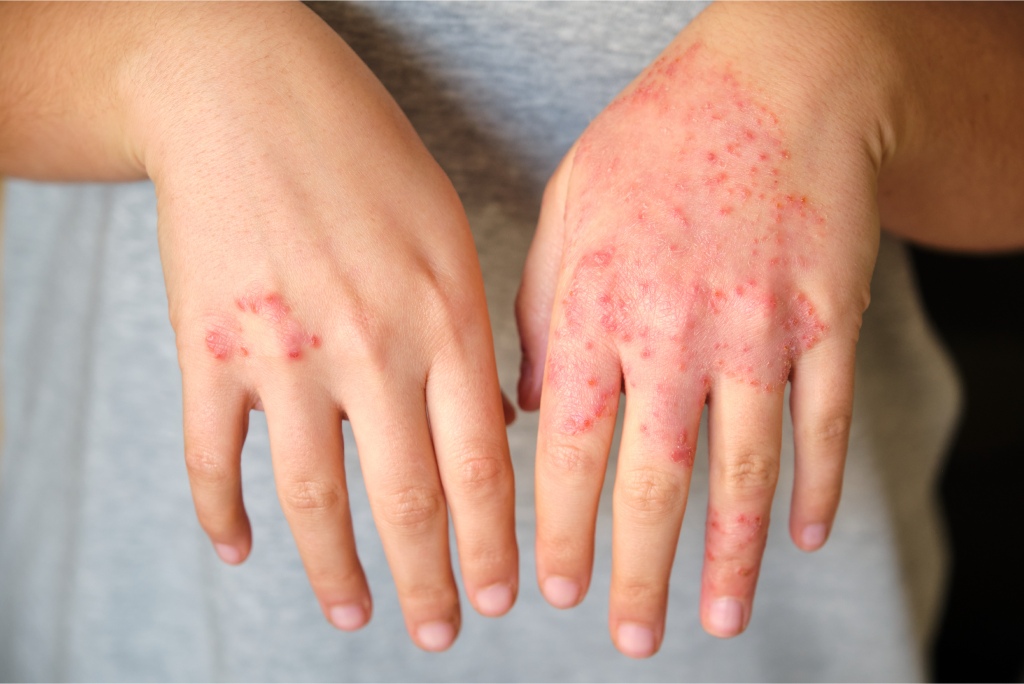 Can Mounjaro Cause Skin Rash or Hives?