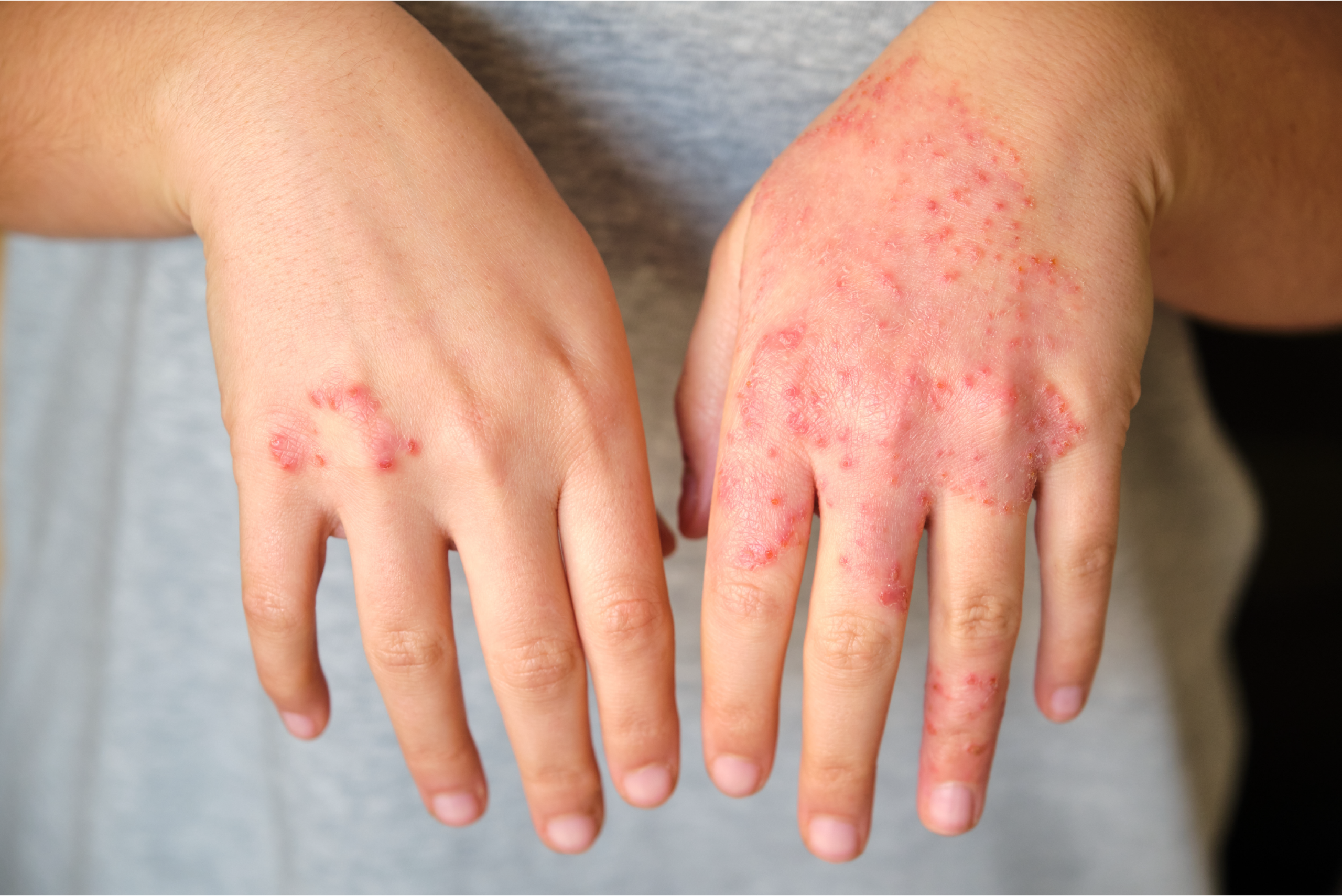 Can Mounjaro Cause Skin Rash or Hives? Symptoms and Warning Signs