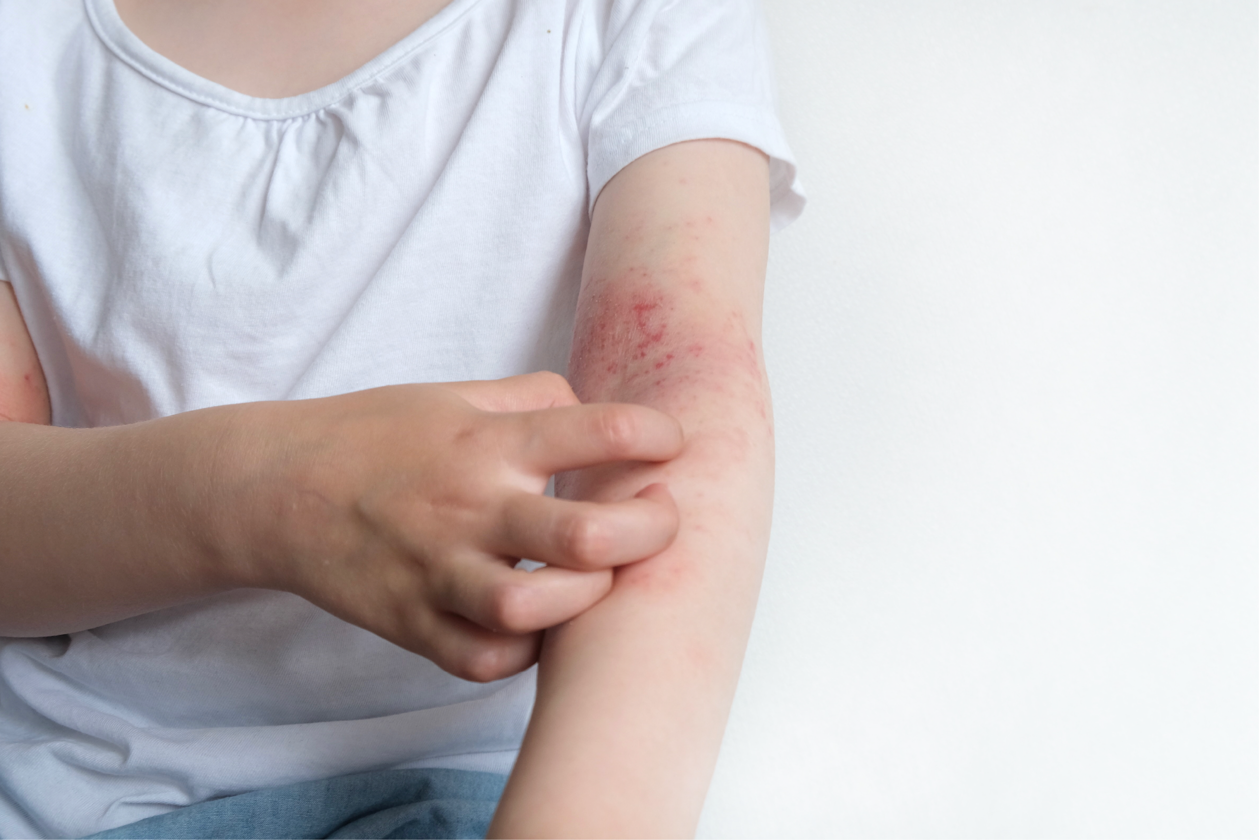 Can Mounjaro Cause Eczema? Understanding Skin Reactions in the UK